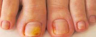 nail fungus symptoms